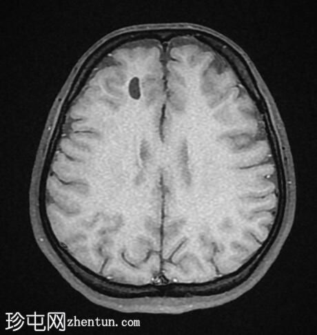 神经胶质囊肿