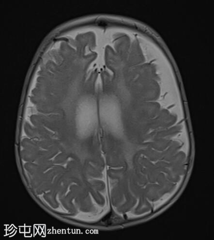 戊二酸尿症1型