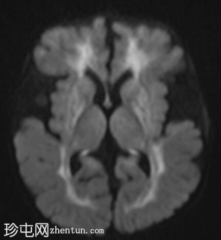 戊二酸尿症1型