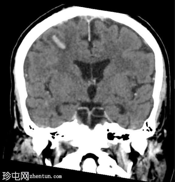 硬脑膜窦血栓