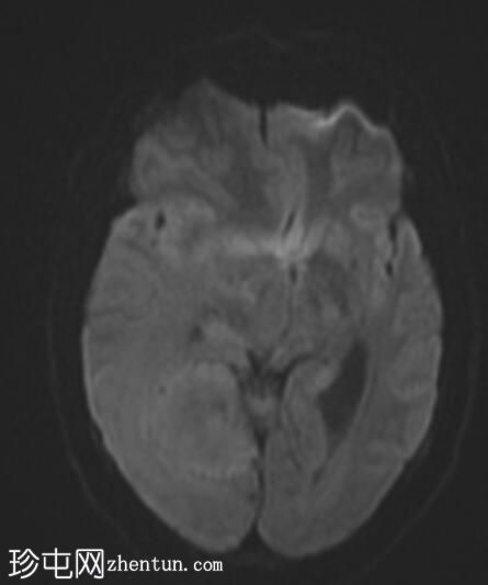 脑膜瘤 - 小脑幕