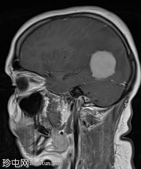 脑膜瘤 - 小脑幕