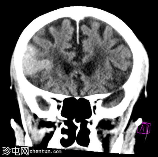 溶栓后对比染色