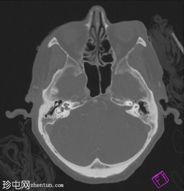 溶栓后对比染色