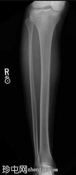 胫骨内侧应力综合征（骨扫描）