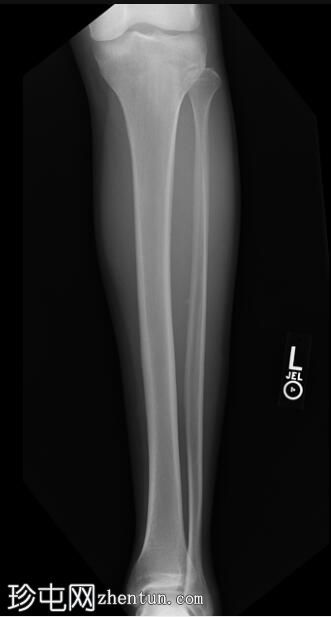 胫骨内侧应力综合征（骨扫描）
