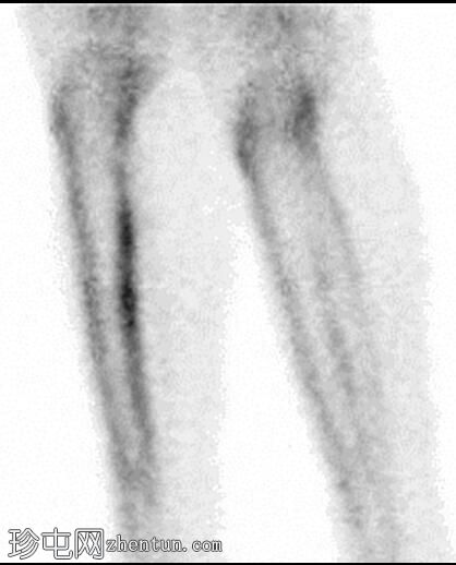 胫骨内侧应力综合征（骨扫描）