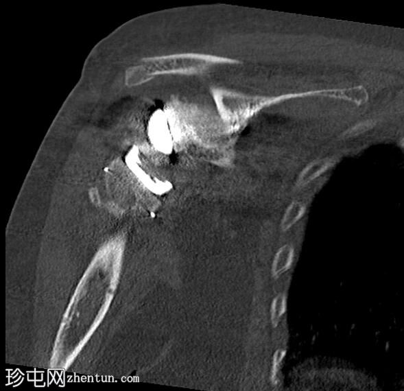 反向全肩关节置换术后肩峰骨折