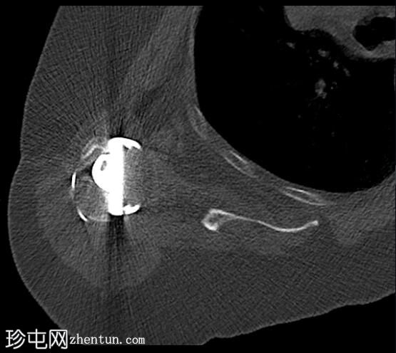 反向全肩关节置换术后肩峰骨折