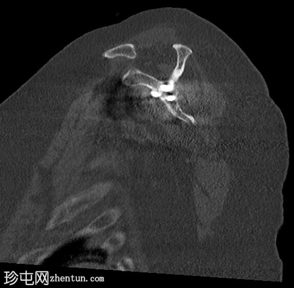 反向全肩关节置换术后肩峰骨折