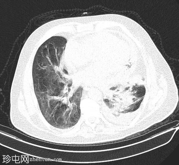 胃心包瘘和主动脉弓假性动脉瘤