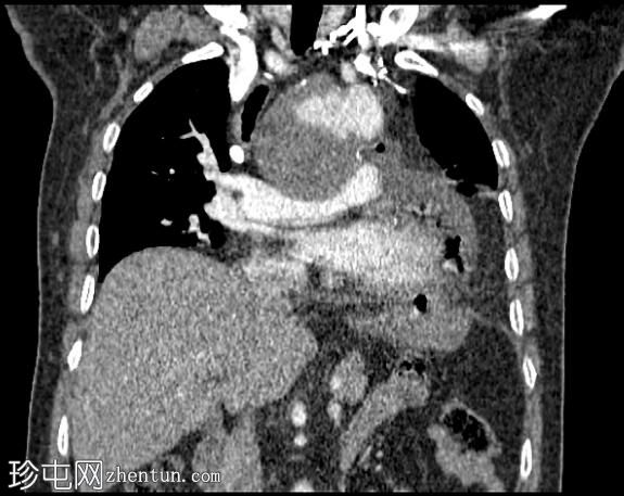 胃心包瘘和主动脉弓假性动脉瘤