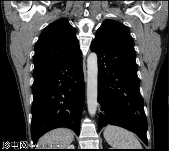 叶内肺隔离症