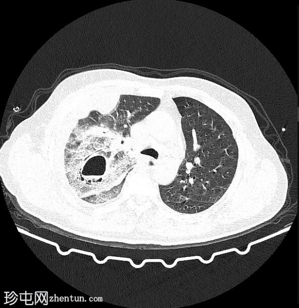 肺动脉霉菌性动脉瘤