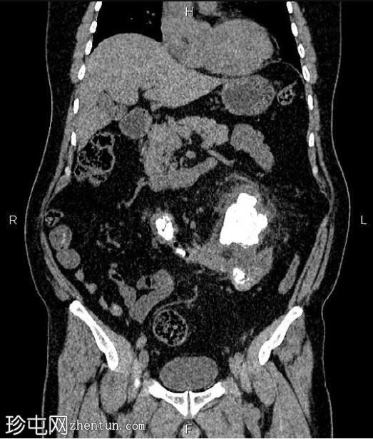 马蹄肾巨大结石