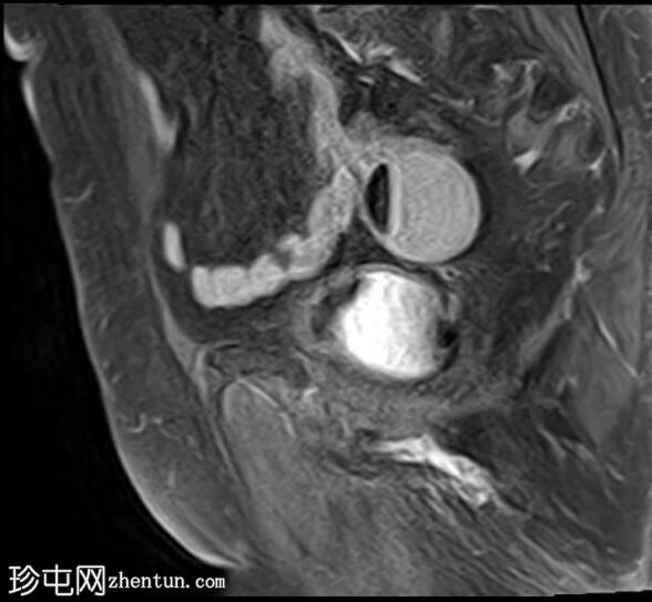 弥漫性子宫腺肌病伴成熟卵巢畸胎瘤