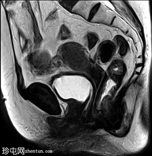 弥漫性子宫腺肌病伴成熟卵巢畸胎瘤