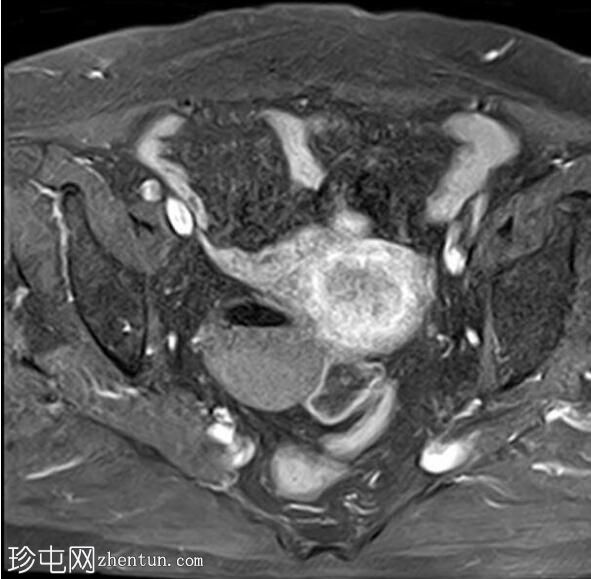 弥漫性子宫腺肌病伴成熟卵巢畸胎瘤