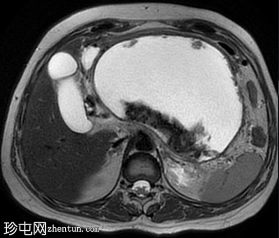 坏死性胰腺炎伴坏死灶封闭