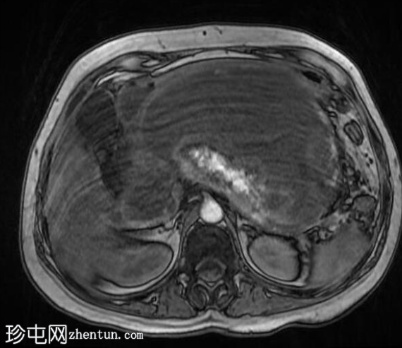 坏死性胰腺炎伴坏死灶封闭