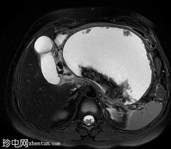 坏死性胰腺炎伴坏死灶封闭