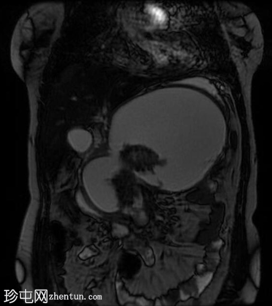 坏死性胰腺炎伴坏死灶封闭