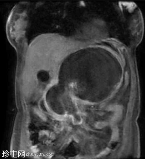 坏死性胰腺炎伴坏死灶封闭