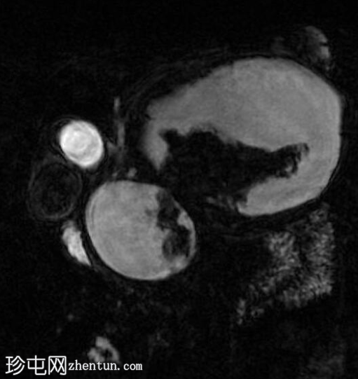 坏死性胰腺炎伴坏死灶封闭