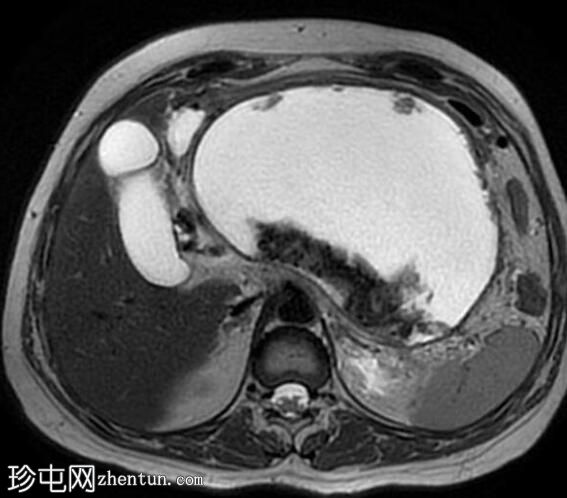 坏死性胰腺炎伴坏死灶封闭