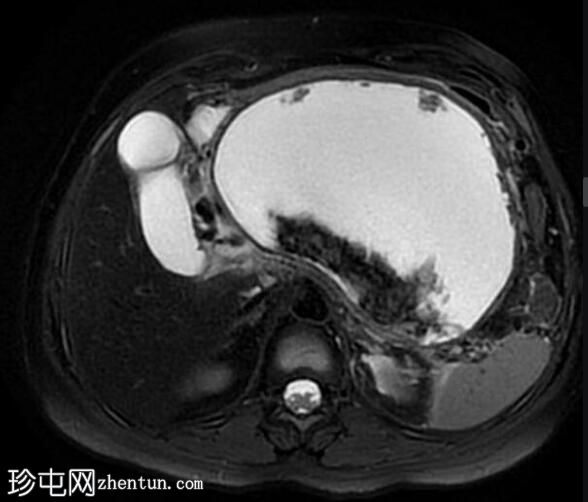 坏死性胰腺炎伴坏死灶封闭