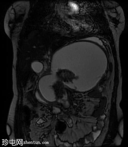 坏死性胰腺炎伴坏死灶封闭