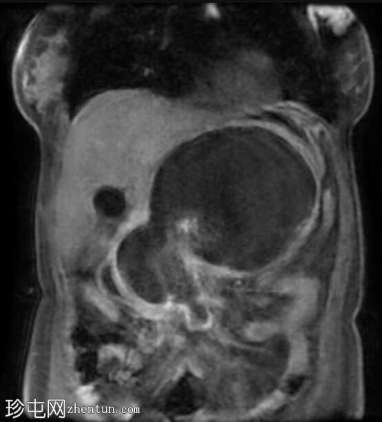 坏死性胰腺炎伴坏死灶封闭