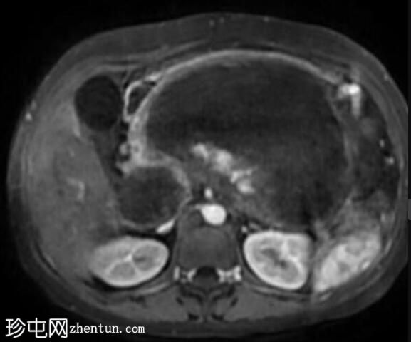 坏死性胰腺炎伴坏死灶封闭