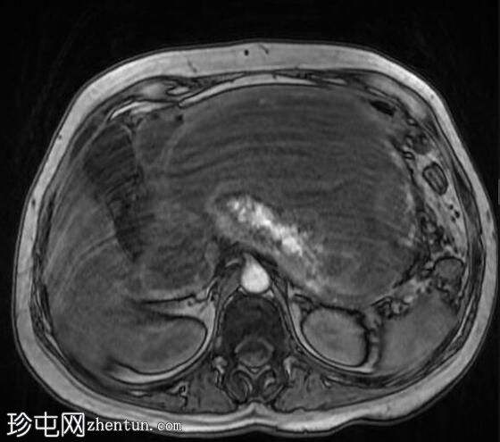 坏死性胰腺炎伴坏死灶封闭