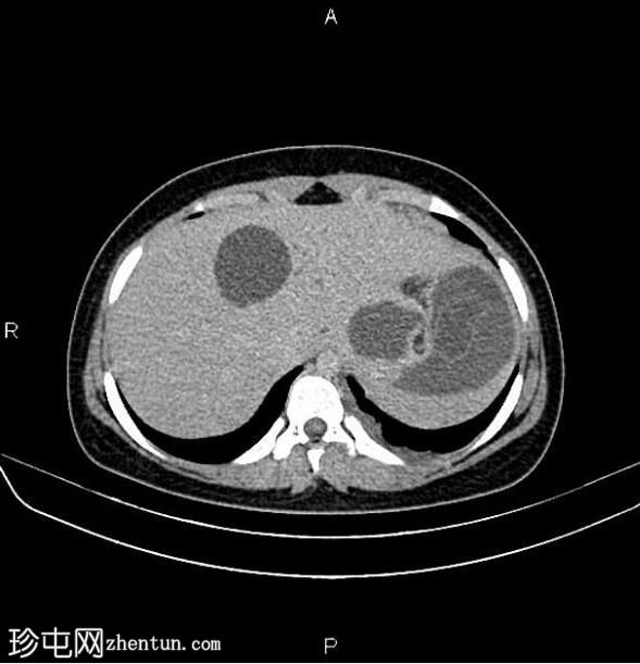 肝包虫囊肿腹腔破裂