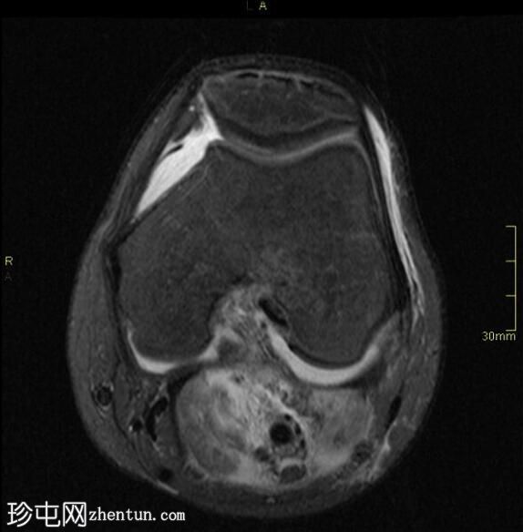 尤因肉瘤（骨扫描）