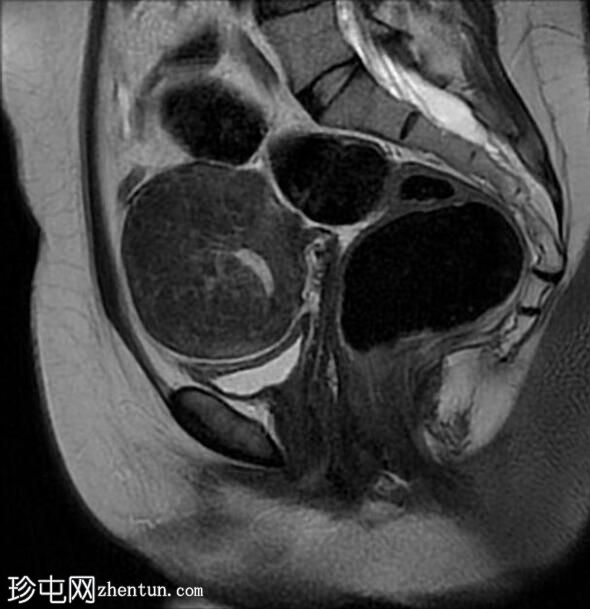 弥漫性子宫腺肌病