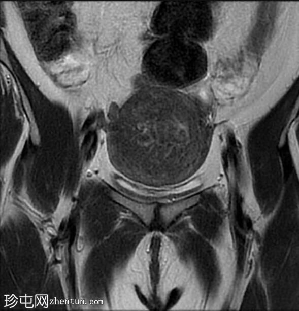 弥漫性子宫腺肌病