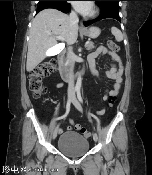 ERCP 后 CT 研究证实胆管囊腺瘤具有胆管连通