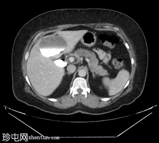 ERCP 后 CT 研究证实胆管囊腺瘤具有胆管连通