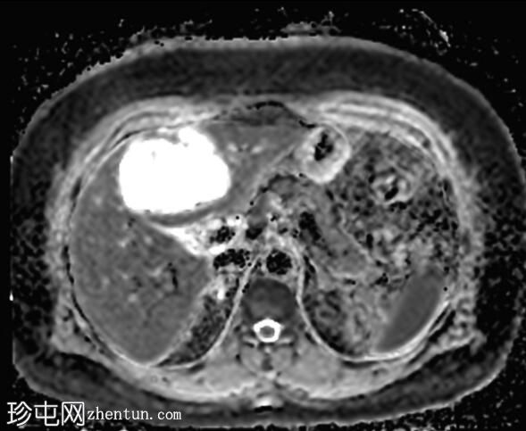 ERCP 后 CT 研究证实胆管囊腺瘤具有胆管连通