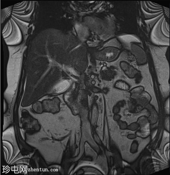 ERCP 后 CT 研究证实胆管囊腺瘤具有胆管连通