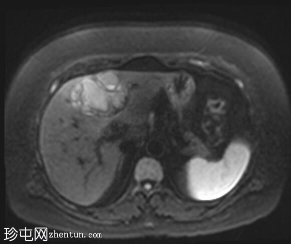 ERCP 后 CT 研究证实胆管囊腺瘤具有胆管连通