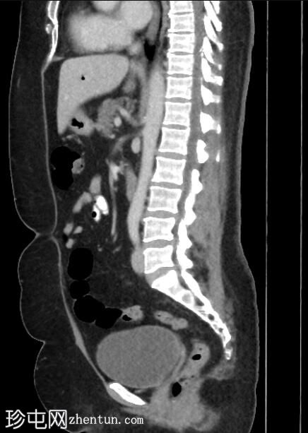 ERCP 后 CT 研究证实胆管囊腺瘤具有胆管连通