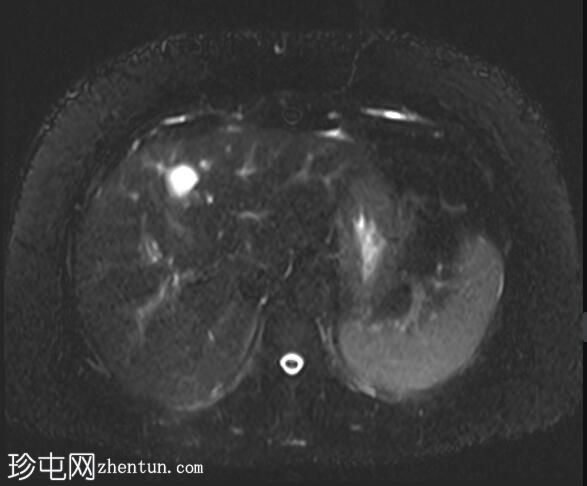 ERCP 后 CT 研究证实胆管囊腺瘤具有胆管连通