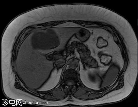 ERCP 后 CT 研究证实胆管囊腺瘤具有胆管连通