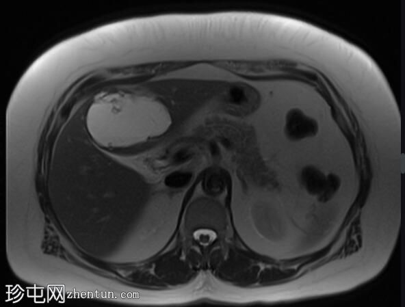 ERCP 后 CT 研究证实胆管囊腺瘤具有胆管连通