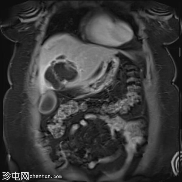 ERCP 后 CT 研究证实胆管囊腺瘤具有胆管连通