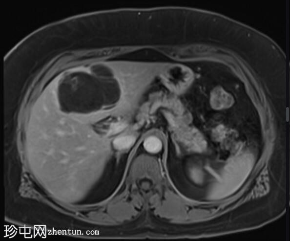 ERCP 后 CT 研究证实胆管囊腺瘤具有胆管连通