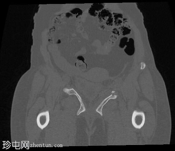 骨盆环侧方压缩骨折